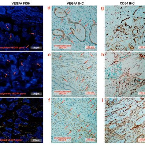 VEGFA Expression And Micro Vessel Density In Control Disease GC