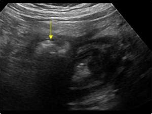 Abdomen and retroperitoneum | 1.6 Gastrointestinal tract : Case 1.6.1 Diverticulosis and ...