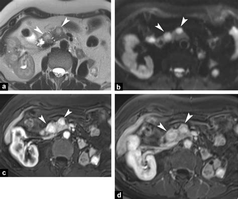 A Year Old Woman With Pancreatic Metastases From Renal Cell