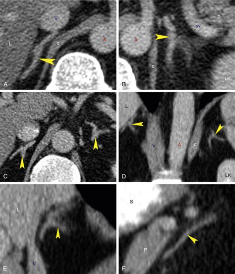 Adrenal Glands Radiology Key