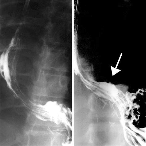 Barium Swallow In A Patient With Cystic Fibrosis Following Right