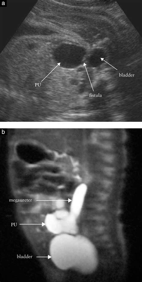 Prenatal Diagnosis Of Enlarged Prostatic Utricle By Ultrasonography And Magnetic Resonance