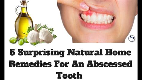 The Best Tooth Abscess Homeopathic Treatment Ideas