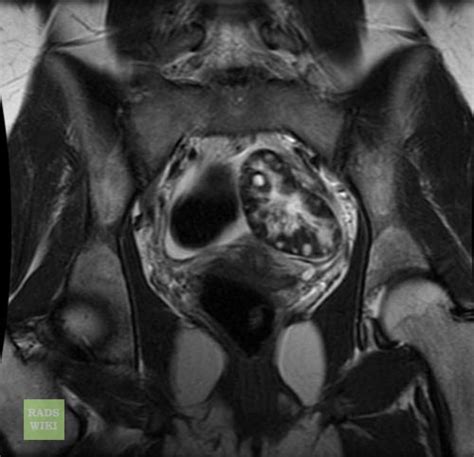 Ovarian Torsion Mri Wikidoc