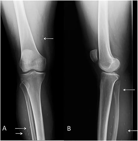 Anteroposterior And Lateral Radiographs Of The Right Knee Download