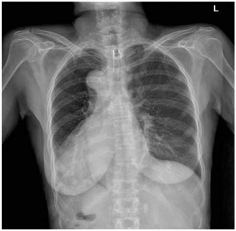 Chest Radiograph Posteroanterior View Showing A Left Right Shifted