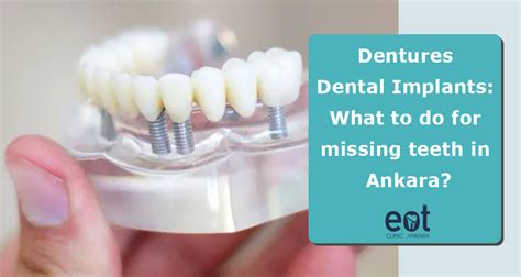 Dentures Dental Implants What To Do For Missing Teeth In Ankara