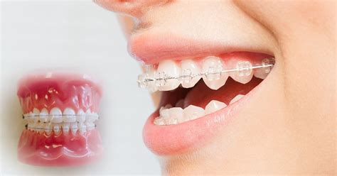 CERAMIC BRACES - vtrustdental