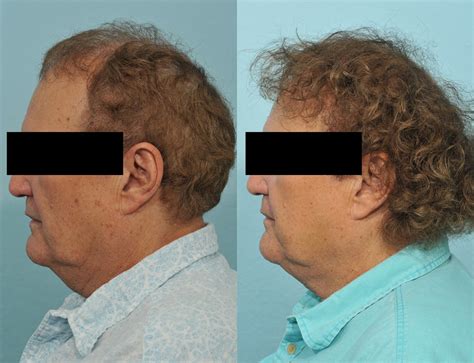 Hair Transplant Before And After 5 Jesse E Smith Md Facs Ft Worth