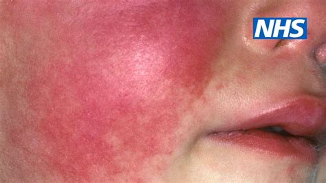 Scarlet Fever Rash Face