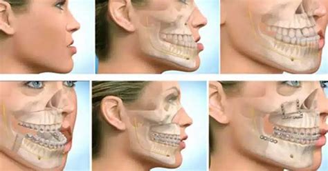 Why People Choose Corrective Jaw Surgery Revision Insights And