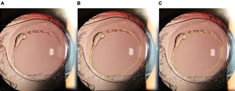 Frontiers Posterior Capsular Outcomes Of Pediatric Cataract Surgery