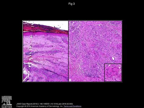 Interferon Alfainduced Sarcoidosis Resolving Without Drug Withdrawal