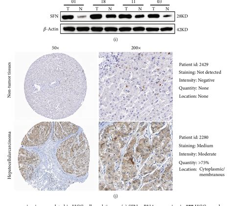 Figure From Stratifin Promotes Hepatocellular Carcinoma Progression