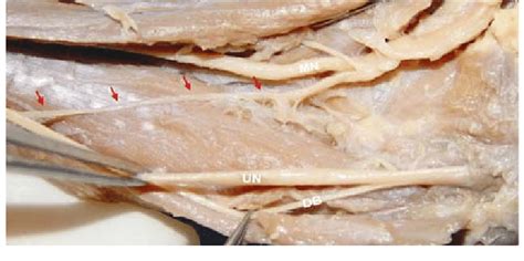 Martin Gruber Anastomosis In A 28 Week Fetus MN Median Nerve UN Ulnar