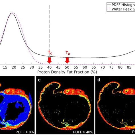 Histogram Of The Proton Density Fat Fraction Histogram Of The Proton