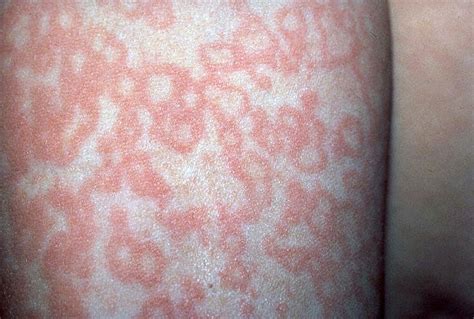 Fifth Disease Picture Hardin Md Super Site Sample