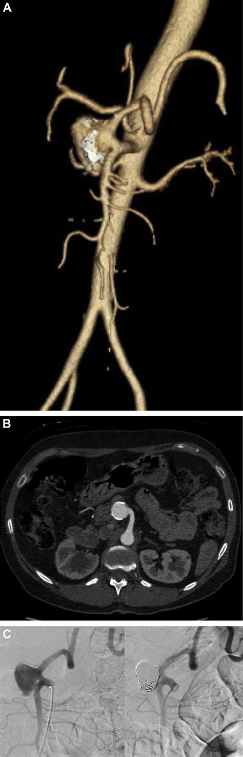 Aneurysm Of The Aberrant Splenic Artery Arising From The Superior Mesenteric Artery Journal Of