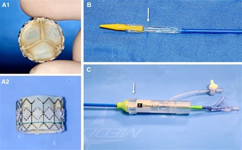 The Edwards Sapien Transcatheter Heart Valve And Retroflex 3