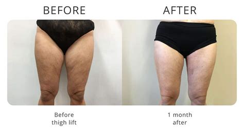 Arm Lift Thigh Lift My Cosmetic Clinic