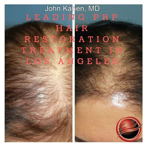 Follicular Unit Extraction Fue Is A Method Where Single Follicular Units Are Extracted