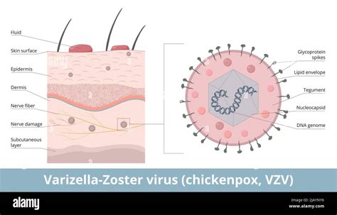 Varicella Zoster Virus Chickenpox Vzv Detailed Scheme Of Varizella