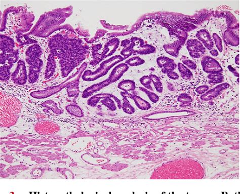 Figure From Intramucosal Gastric Mixed Adenoneuroendocrine Carcinoma