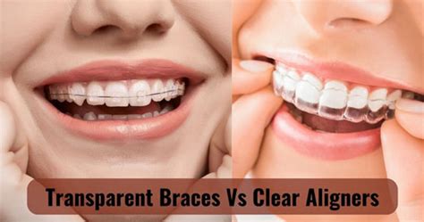 Ceramic Braces Vs Clear Aligners Which Will Suit You Better