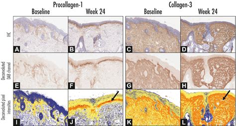 Pdf Adapalene 03 Gel Shows Efficacy For The Treatment Of Atrophic