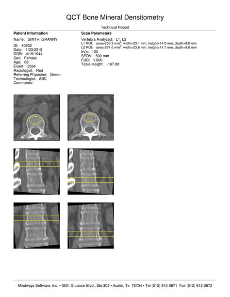 Mindways Qct Pro Bone Density Report Samples