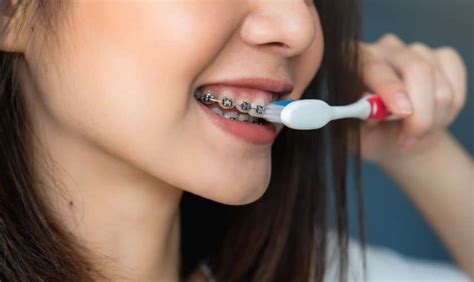 How To Maintain Oral Hygiene With Braces