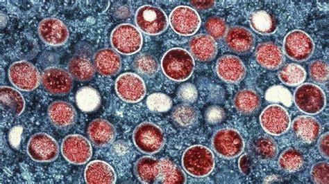 WHO Chief Advises Reducing Sex Partners As Monkeypox Cases Surge Globally Today News