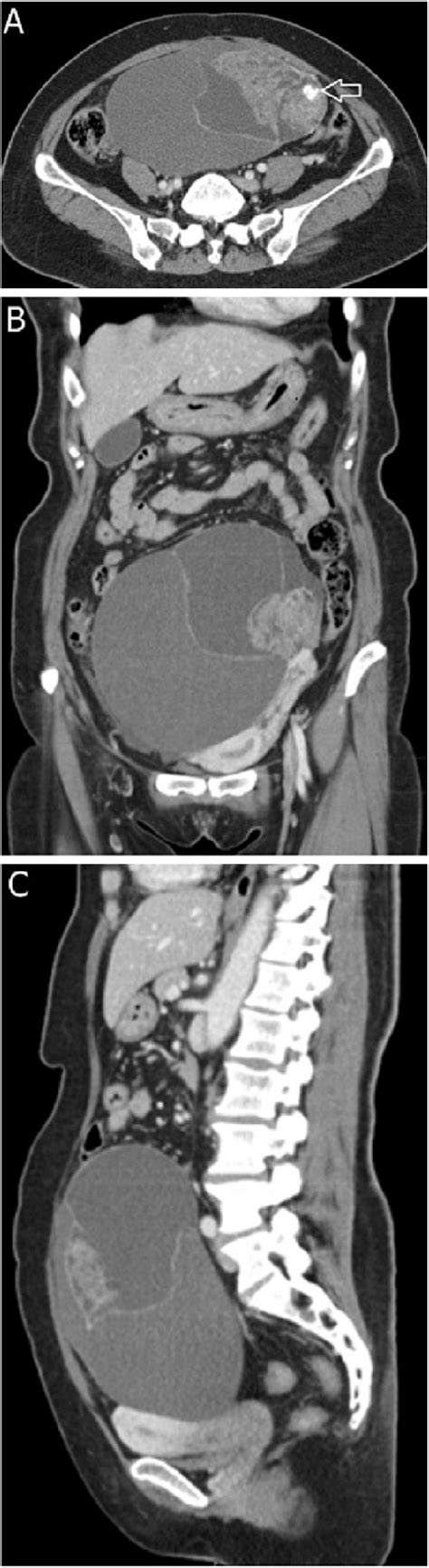 Malignant Brenner Tumor Of The Ovary In A 61 Year Old Woman