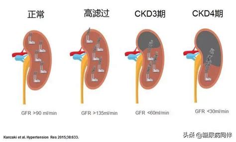 糖尿病肾脏病指南及专家共识解读（上） 肾脏病 糖尿病 新浪新闻