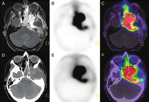 68 Ga DOTATOC PET MRI A C And PET CT D F Of Patient 11