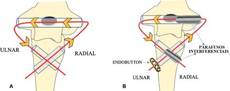 SciELO Brasil Multidirectional Instability In A Neglected Elbow