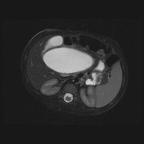 Choledochal Cyst Type I Image