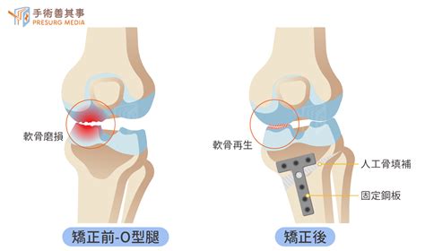 退化性膝關節炎的攻略集：如何評估手術？