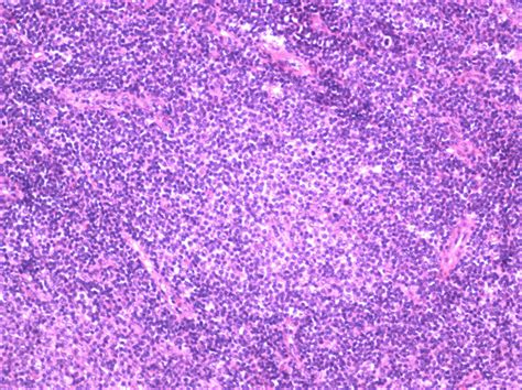 Nodal Marginal Zone Lymphoma Nmzl