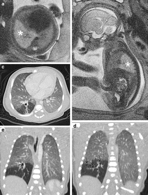 Complex Congenital Lung Malformation In A Male Fetusinfant Mri