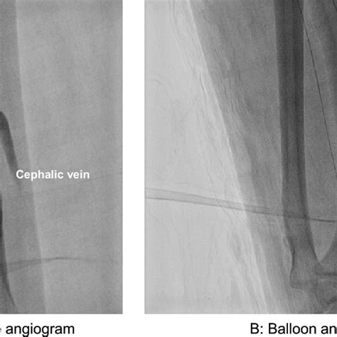 A Radiocephalic Fistula Using Superficial Radial Artery Solid Arrow