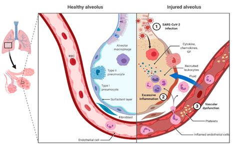 This Figure Compares The Alveolar Immune Responses In Healthy And