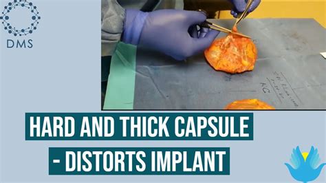 Capsular Contracture Hard And Thick Capsule Distorts Implant