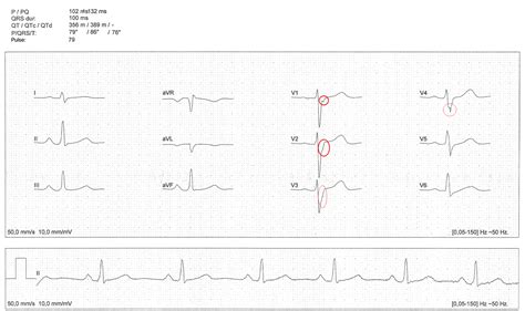 Ekg Intraventricular Conduction Delay Causes M R Askdocs