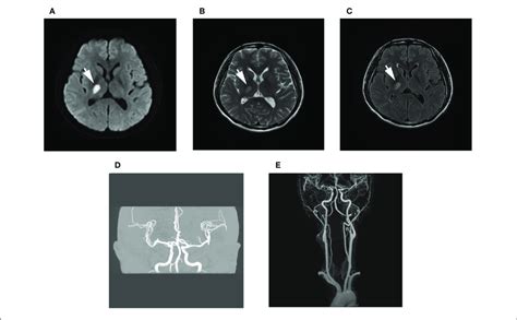 Brain Magnetic Resonance Imaging Mri A C Diffusion Weighted Download Scientific Diagram