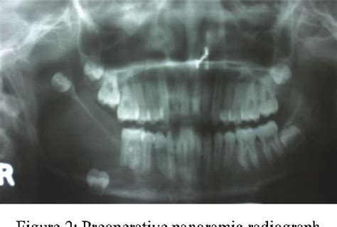 Figure From Conservative Management Of Unicystic Ameloblastoma In A