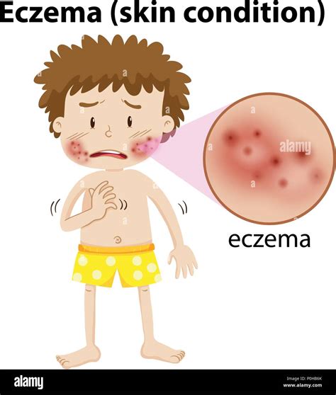 A Young Boy Having Eczema Illustration Stock Vector Image And Art Alamy