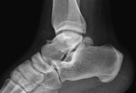 Ankle Arthroscopy In A Hanging Position Combined With Hindfoot Endoscopy For The Treatment Of