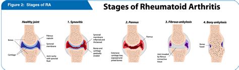 Etveza – Rheumatoid Arthritis