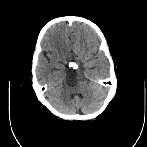 Radiopaedia Case Adamantinomatous Craniopharyngioma Id Study